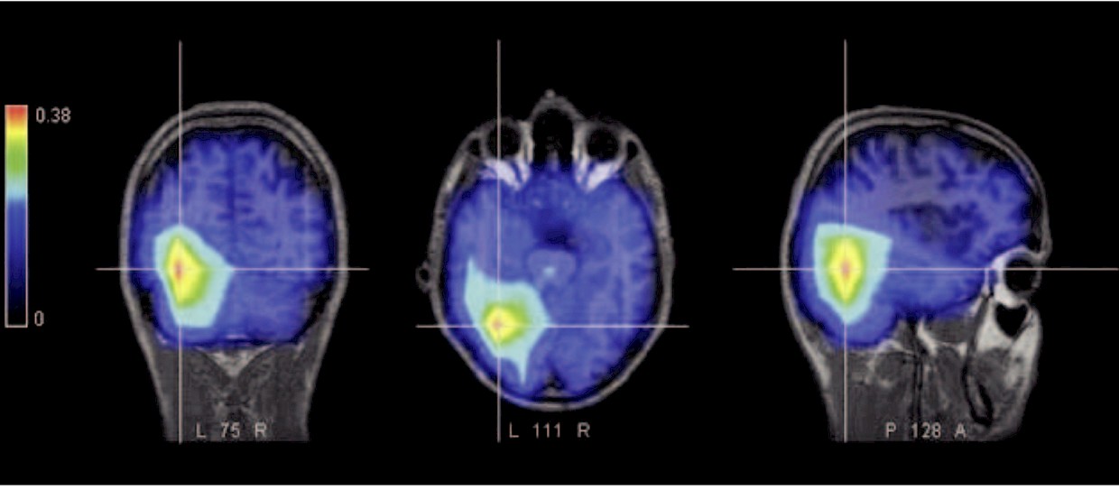 Come sono rappresentate le lingue nel cervello umano