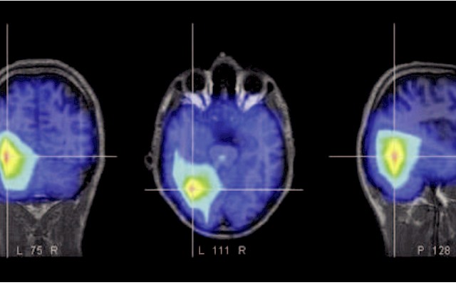 Come sono rappresentate le lingue nel cervello umano