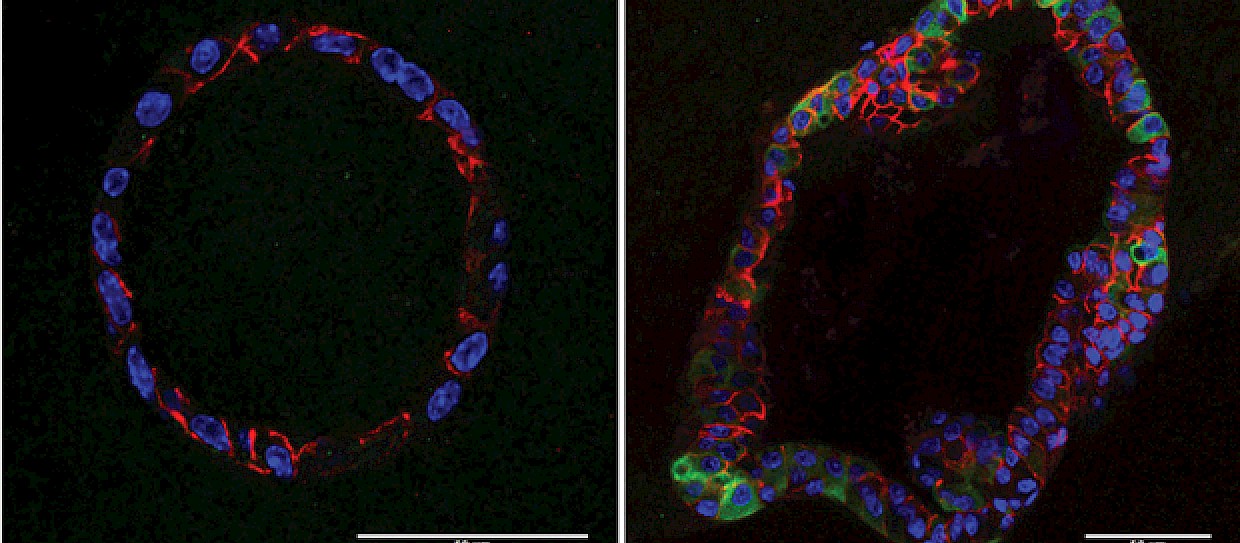 Cell changes drive breast cancer relapse