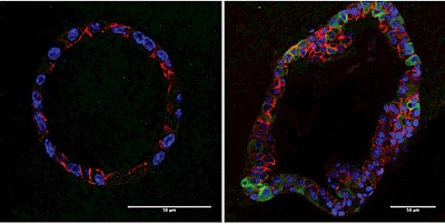 In organoid cultures, mouse residual breast cancer cells (right) have elevated lipid metabolism (green). IMAGE: Jechlinger/EMBL