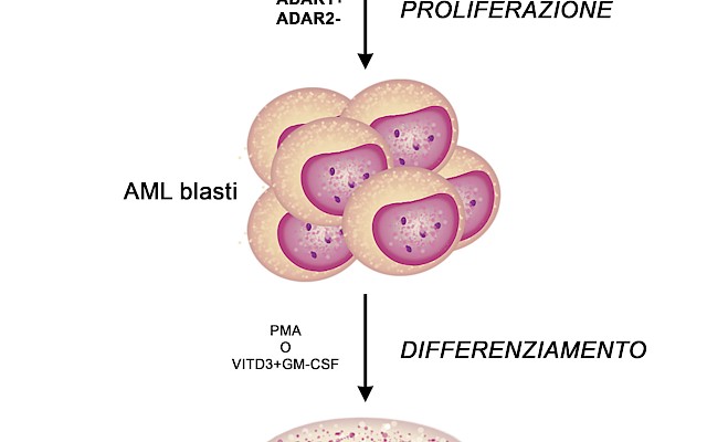 Identificati nuovi marcatori molecolari della leucemia mieloide acuta (LMA)