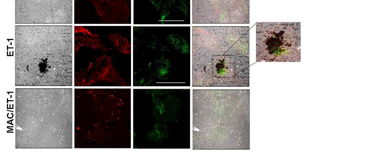 TUMORE OVARICO: DEFINITA INTERAZIONE TRE PROTEINE, INSIEME PROMUOVONO METASTASI