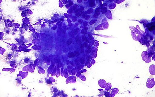 Le cellule tumorali vanno in letargo per evitare la chemioterapia?